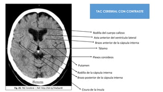 Fig. 25. TAC Cerebral. | Ref. http://bit.ly/1fw0aeW
TAC CEREBRAL CON CONTRASTE
Asta anterior del ventrículo lateral
Tálamo
Rodilla del cuerpo calloso
Brazo anterior de la cápsula interna
Rodilla de la cápsula interna
Brazo posterior de la cápsula interna
Putamen
Cisura de la ínsula
Plexos coroideos
 
