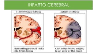 INFARTO CEREBRAL
 