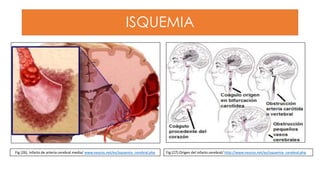 ISQUEMIA
Fig (26). Infarto de arteria cerebral media/ www.neuros.net/es/isquemia_cerebral.php Fig (27).Origen del infarto cerebral/ http://www.neuros.net/es/isquemia_cerebral.php
 
