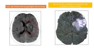 TAC de infarto en los ganglios de la base
RM de infarto cerebral en el territorio de
la arteria cerebral media
 