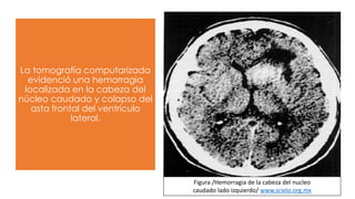 La tomografía computarizada
evidenció una hemorragia
localizada en la cabeza del
núcleo caudado y colapso del
asta frontal del ventrículo
lateral.
Figura /Hemorragia de la cabeza del nucleo
caudado lado izquierdo/ www.scielo.org.mx
 