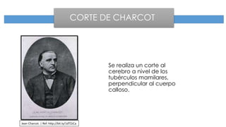 Se realiza un corte al
cerebro a nivel de los
tubérculos mamilares,
perpendicular al cuerpo
calloso.
Jean Charcot. | Ref. http://bit.ly/1dTZzCa
CORTE DE CHARCOT
 