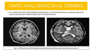 DAÑO AXIAL DIFUSO EN EL CEREBRO
• Es un daño traumático del encéfalo provocado por un movimiento brusco, causando ruptura de
axones (lesiones por cizallamiento) y de la microvasculatura.
Fig ( y ). RM corte axial (Flechsig)/foco edemastomoso talámico, lado derecho/ www.scielo.cl
 