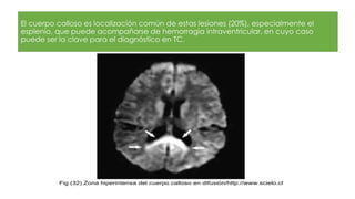 El cuerpo calloso es localización común de estas lesiones (20%), especialmente el
esplenio, que puede acompañarse de hemorragia intraventricular, en cuyo caso
puede ser la clave para el diagnóstico en TC.
Fig (32).Zona hiperintensa del cuerpo calloso en difusión/http://www.scielo.cl
 