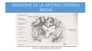 SINDROME DE LA ARTERIA CEREBRAL
MEDIA
Fig (34).Corte coronal con infarto en la art. Cerebral media y crecimiento del ventriculo lateral/Neuroanatomía
Funcional – Afifi 2ed.pdf/Capitulo 28/ pag (359-360)
 