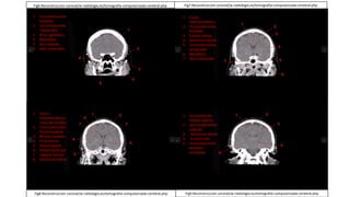 Fig7.Reconstruccion coronal/w-radiología.es/tomografía-computarizada-cerebral.php
1. Circunvoluciones
frontales
2. Circunvoluciones
Temporales
3. Arco cigomático
4. Mandíbula
5. Arco alveolar
6. Seno esfenoidal
1. Cisura
Interhemisferica
2. Circunvoluciones
frontales
3. Cuerpo calloso
4. Ventrículo lateral
5. Circunvoluciones
temporales
6. Mandíbula
7. Seno esfenoidal
1. Cisura
Interhemisferica
/ Hoz del cerebro
2. Circunvoluciones
frontal superior
3. Núcleo caudado
4. III ventrículo
5. Arteria basilar
6. Núcleo lenticular
7. Capsula interna
8. Ventrículo lateral
1. Circunvolución
frontal superior
2. Seno longitudinal
superior
3. Ventrículo lateral
4. III ventrículo
5. Circunvoluciones
temporo-
occipitales
Fig6.Reconstruccion coronal/w-radiología.es/tomografía-computarizada-cerebral.php
Fig8.Reconstruccion coronal/w-radiología.es/tomografía-computarizada-cerebral.php Fig9.Reconstruccion coronal/w-radiología.es/tomografía-computarizada-cerebral.php
 