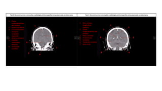 1. Cisura
Longitudinal/Hoz
del cerebro
2. Ventrículo lateral
3. Circunvoluciones
temporo-
iccipitales
izquierdo
4. Arteria vertebral
5. Celdillas
mastoideas
derecho
6. Tronco del
encéfalo
1. Seno venoso
longitudinal
superior
2. Cisura
longitudinal/Hoz del
cerebro
3. Plexo coroideo
4. IV ventrículo
5. Cerebelo
6. Tienda del cerebelo
7. Seno recto
Fig10.Reconstruccion coronal/w-radiología.es/tomografía-computarizada-cerebral.php Fig11.Reconstruccion coronal/w-radiología.es/tomografía-computarizada-cerebral.php
 