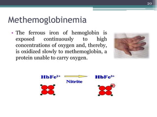 Methemoglobinemia
• The ferrous iron of hemoglobin is
exposed continuously to high
concentrations of oxygen and, thereby,
is oxidized slowly to methemoglobin, a
protein unable to carry oxygen.
20
 