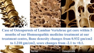 Osteoporosis & Homoeopathy