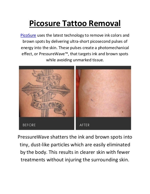 Art Of Dermatology : Picosure Tattoo Removal in New York City