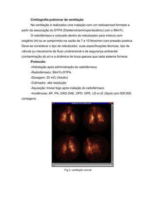 Cintilografia pulmonar de ventilação
      Na ventilação é realizados uma inalação com um radioaerosol formado a
partir da associação do DTPA (Dietilenotriaminopentacético) com o 99mTc.
      O radiofármaco e colocado dentro do nebulizador para mistura com
oxigênio (H) ou ar comprimido na vazão de 7 a 10 litros/min com pressão positiva.
Deve-se considerar o tipo de nebulizador, suas especificações técnicas, tipo de
válvula ou mecanismo de fluxo unidirecional e de segurança ambiental
(contaminação do ar) e a dinâmica de troca gasosa que cada sistema fornece.
      Protocolo:
      -Hidratação após administração do radiofármaco
      -Radiofármaco: 99mTc-DTPA.
      -Dosagem: 20 mCi (Adulto)
      -Colimador: alta resolução
      -Aquisição: Iniciar logo após inalação do radiofármaco
      -Incidências: AP, PA, OAD.OAE, OPD, OPE, LD e LE (Spot) com 500.000
contagens.




                               Fig.3: ventilação normal
 