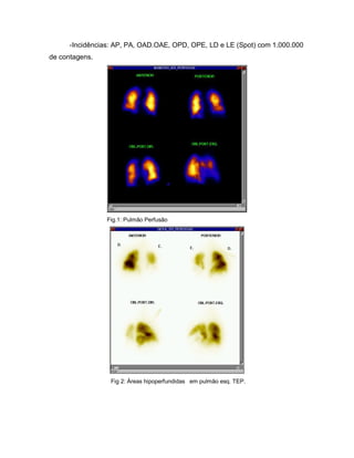 -Incidências: AP, PA, OAD.OAE, OPD, OPE, LD e LE (Spot) com 1.000.000
de contagens.
Fig.1: Pulmão Perfusão
Fig 2: Áreas hipoperfundidas em pulmão esq. TEP.
 