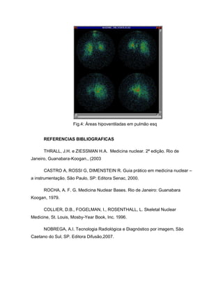 Fig.4: Áreas hipoventiladas em pulmão esq
REFERENCIAS BIBLIOGRAFICAS
THRALL, J.H. e ZIESSMAN H.A. Medicina nuclear. 2ª edição. Rio de
Janeiro, Guanabara-Koogan., (2003
CASTRO A, ROSSI G, DIMENSTEIN R. Guia prático em medicina nuclear –
a instrumentação. São Paulo, SP: Editora Senac, 2000.
ROCHA, A. F. G. Medicina Nuclear Bases. Rio de Janeiro: Guanabara
Koogan, 1979.
COLLIER, D.B., FOGELMAN, I., ROSENTHALL, L. Skeletal Nuclear
Medicine, St. Louis, Mosby-Year Book, Inc. 1996.
NOBREGA, A.I. Tecnologia Radiológica e Diagnóstico por imagem, São
Caetano do Sul, SP. Editora Difusão,2007.
 