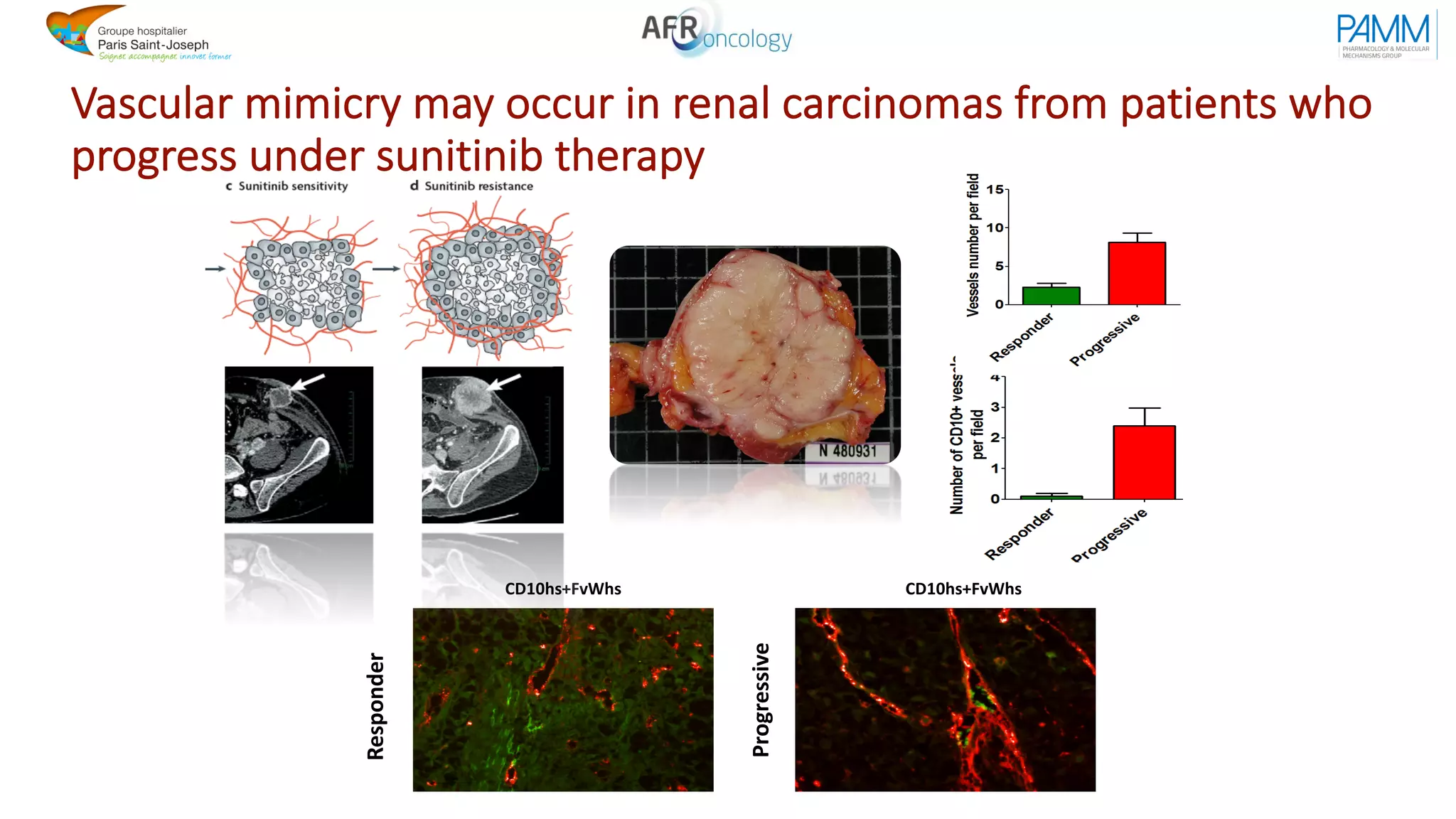 Vascular mimicry may occur in renal carcinomas from patients who
progress under sunitinib therapy
Responder
Progressive
CD10hs+FvWhs CD10hs+FvWhs
 