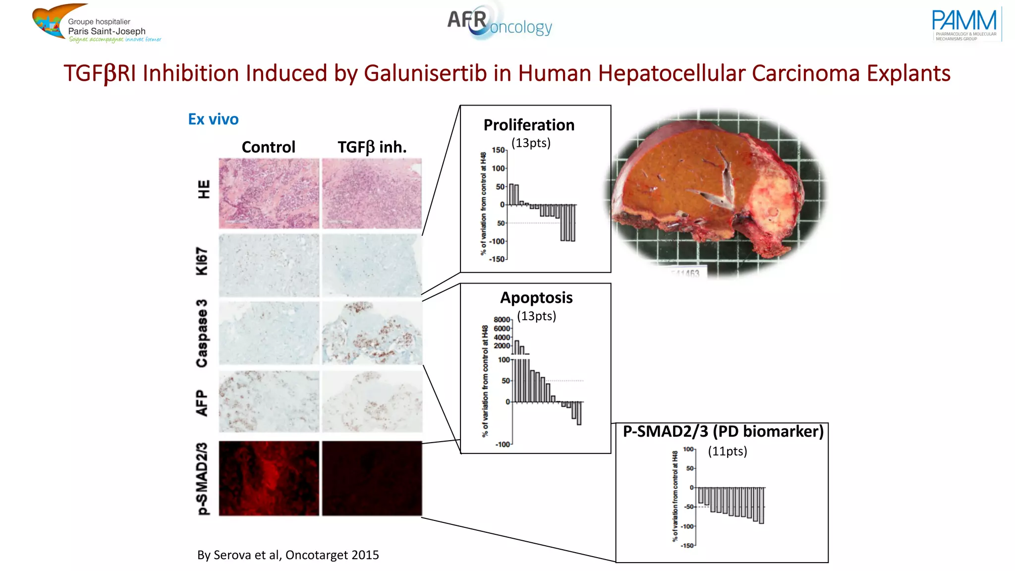 TGFbRI Inhibition Induced by Galunisertib in Human Hepatocellular Carcinoma Explants
Ex vivo Proliferation
Control TGFb inh.
Apoptosis
P-SMAD2/3 (PD biomarker)
(13pts)
(13pts)
(11pts)
By Serova et al, Oncotarget 2015
 