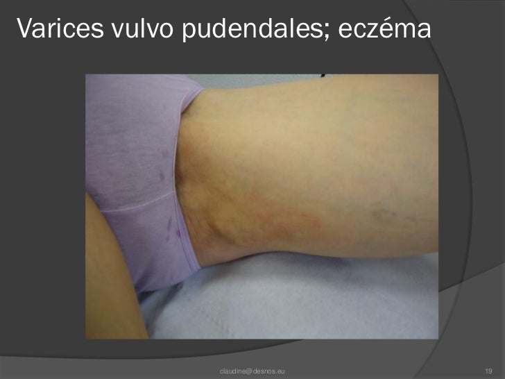 Pdf Varices Vulvaires Hamel Desnos 23 01 11 Chamonix
