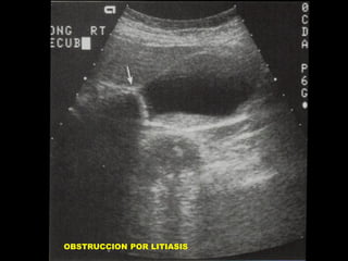 OBSTRUCCION POR LITIASIS

 