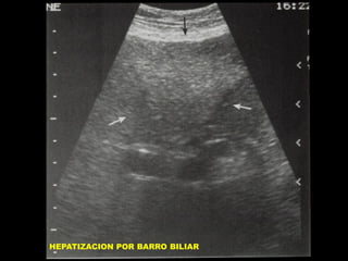 HEPATIZACION POR BARRO BILIAR

 