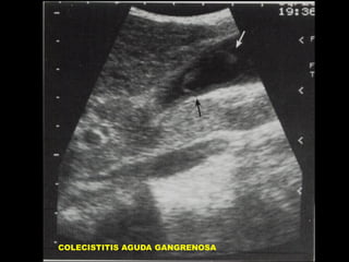 COLECISTITIS AGUDA GANGRENOSA

 