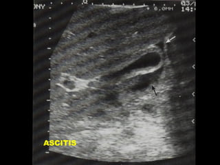 ASCITIS

 