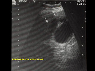 PERFORACION VESICULAR

 