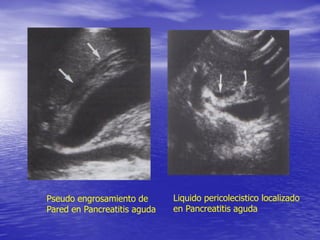 Pseudo engrosamiento de
Pared en Pancreatitis aguda

Liquido pericolecistico localizado
en Pancreatitis aguda

 
