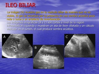 ILEO BILIAR
La imágen (A) muestra gas en la vesícula biliar de manera que no es
visible. El gas se reconoce por la presencia de una sombra acústica poco
neta o sucia y un artefacto de reverberación.
Las imágenes ecográficas (B y C) son cortes a nivel de la región
infraumbilical izquierda y muestran un asa de ileon dilatada y un cálculo
vesicular en el lúmen, el cual produce sombra acústica.

 