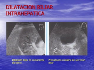 DILATACION BILIAR
INTRAHEPATICA

Dilatación biliar en cornamenta
de ciervo

Precipitación cristalina de secreción
biliar

 