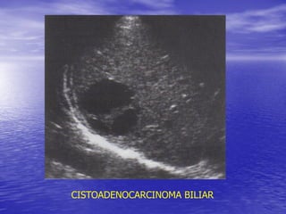 CISTOADENOCARCINOMA BILIAR

 