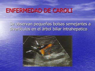 ENFERMEDAD DE CAROLI
Se observan pequeñas bolsas semejantes a
divertículos en el árbol biliar intrahepatico

 