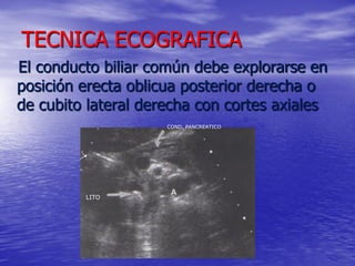 TECNICA ECOGRAFICA
El conducto biliar común debe explorarse en
posición erecta oblicua posterior derecha o
de cubito lateral derecha con cortes axiales
COND. PANCREATICO

LITO

 