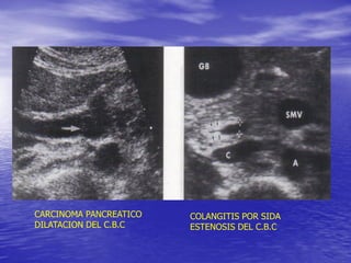 CARCINOMA PANCREATICO
DILATACION DEL C.B.C

COLANGITIS POR SIDA
ESTENOSIS DEL C.B.C

 