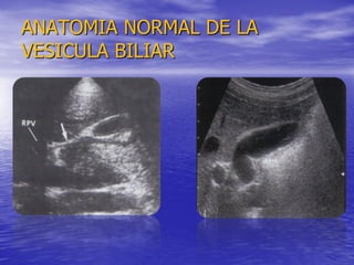 ANATOMIA NORMAL DE LA
VESICULA BILIAR

 