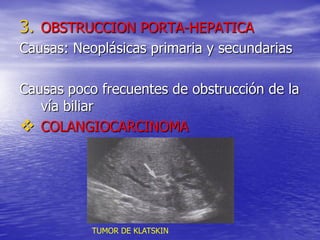 3. OBSTRUCCION PORTA-HEPATICA
Causas: Neoplásicas primaria y secundarias
Causas poco frecuentes de obstrucción de la
vía biliar
 COLANGIOCARCINOMA

TUMOR DE KLATSKIN

 
