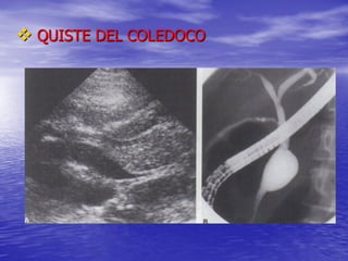  QUISTE DEL COLEDOCO

 