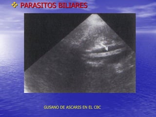  PARASITOS BILIARES

GUSANO DE ASCARIS EN EL CBC

 