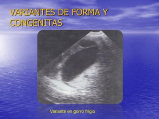 VARIANTES DE FORMA Y
CONGENITAS

Variante en gorro frigio

 