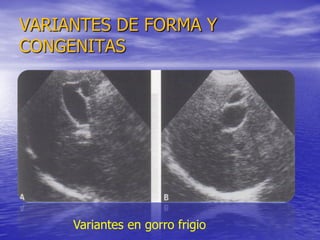 VARIANTES DE FORMA Y
CONGENITAS

Variantes en gorro frigio

 