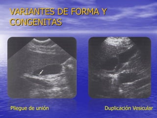 VARIANTES DE FORMA Y
CONGENITAS

Pliegue de unión

Duplicación Vesicular

 
