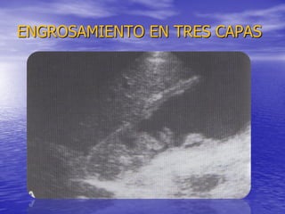 ENGROSAMIENTO EN TRES CAPAS

 
