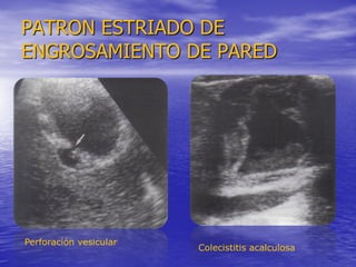 PATRON ESTRIADO DE
ENGROSAMIENTO DE PARED

Perforación vesicular

Colecistitis acalculosa

 