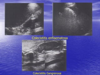 Colecistitis enfisematosa

Colecistitis Gangrenosa

 