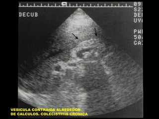 VESICULA CONTRAIDA ALREDEDOR
DE CALCULOS. COLECISTITIS CRONICA

 