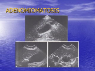ADENOMIOMATOSIS

 
