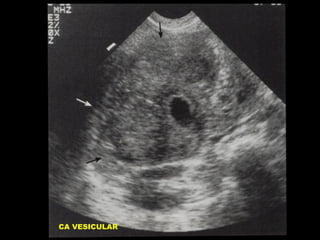 CA VESICULAR

 