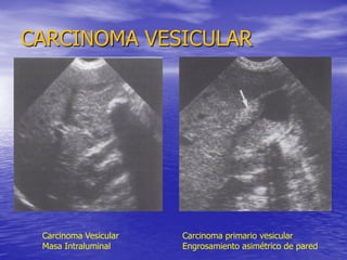 CARCINOMA VESICULAR

Carcinoma Vesicular
Masa Intraluminal

Carcinoma primario vesicular
Engrosamiento asimétrico de pared

 