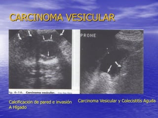 CARCINOMA VESICULAR

Calcificación de pared e invasión
A Hígado

Carcinoma Vesicular y Colecistitis Aguda

 