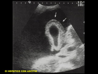 CI HEPATICO CON ASCITIS

 