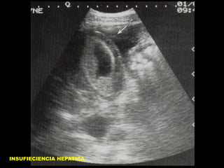 INSUFIECIENCIA HEPATICA

 