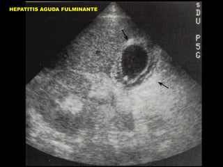HEPATITIS AGUDA FULMINANTE

 